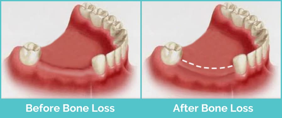 Bone Loss in Teeth 1