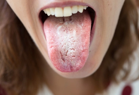 How To Get Rid Of White Tongue: 5 Helpful Solutions