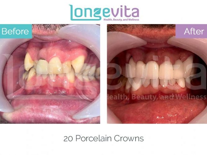 Dental crowns straight teeth