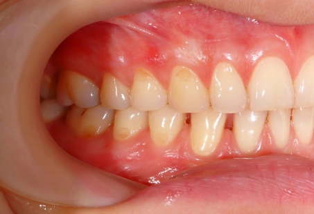 Crossbite: What Is It, Symptoms, Causes & Treatments 