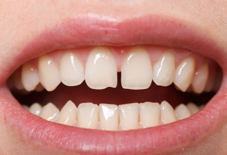 Diastema: Causes, Treatment & Prevention 