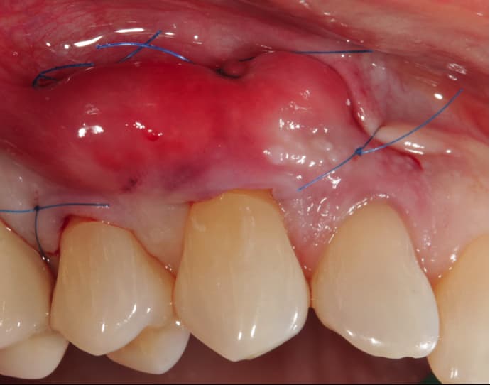 Gum graft sutures
