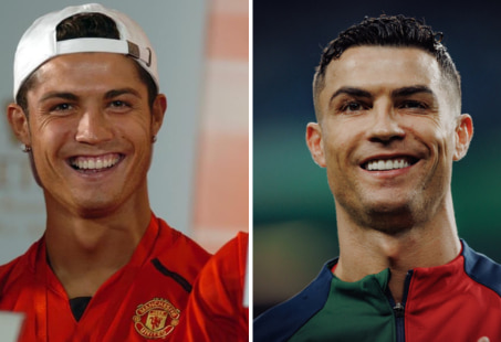 Ronaldo's teeth before and after
