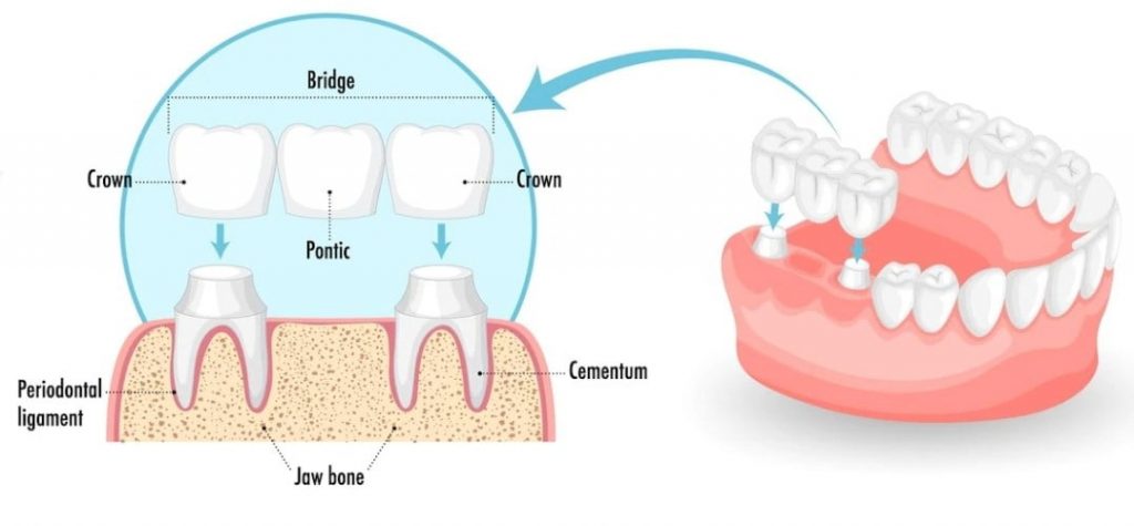 Dental bridge structure