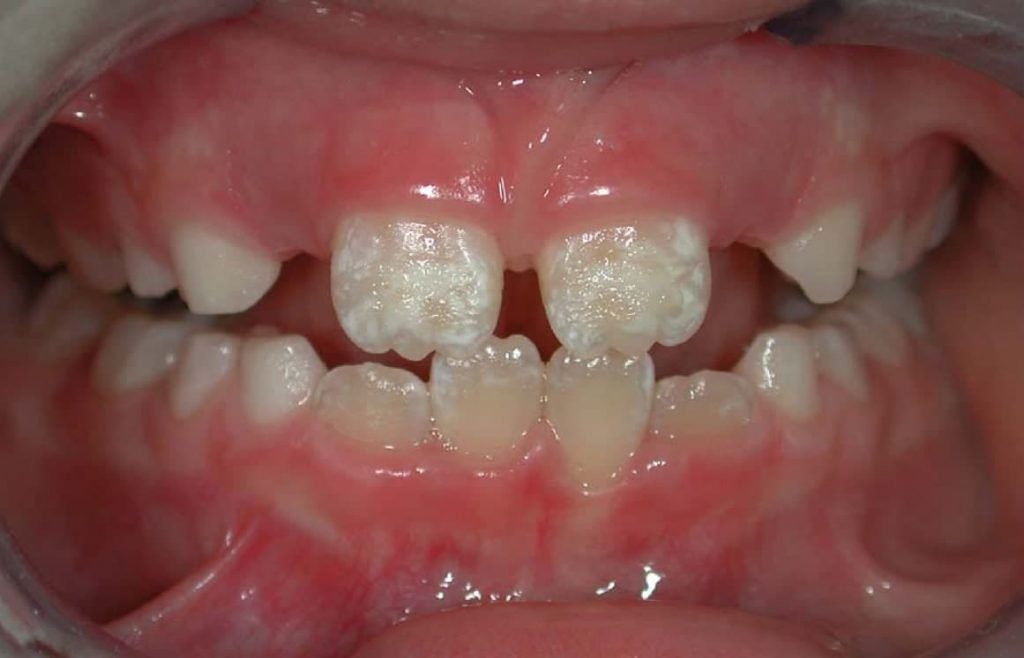 Enamel hypoplasia translucent teeth