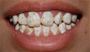 Hypoplastic teeth