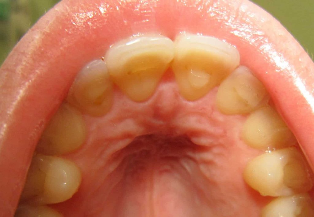 Loss of enamel due to bulimia
