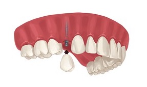 Mini dental implant