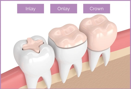 Onlay Vs Crown Which One s Better Longevita Dental