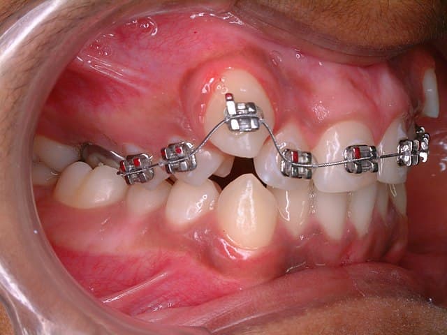 Braces for abfraction