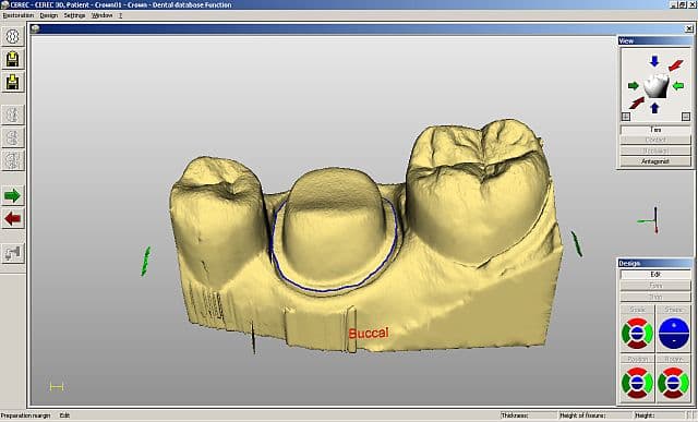 CEREC 3D teeth model
