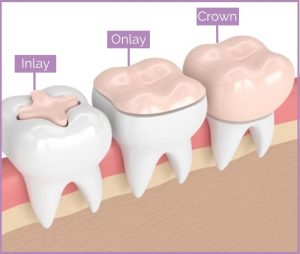 Onlay Vs Crown Which One s Better Longevita Dental Onlay Vs Crown Which One s Better Longevita Dental