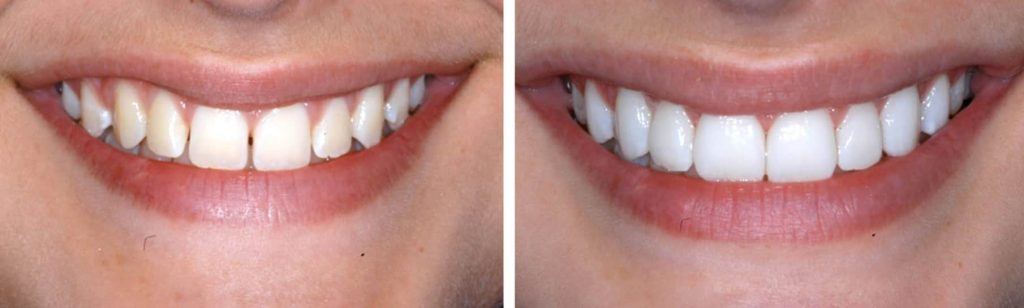 No prep veneers before and after