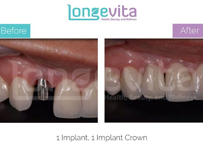 dental implant before and after 4