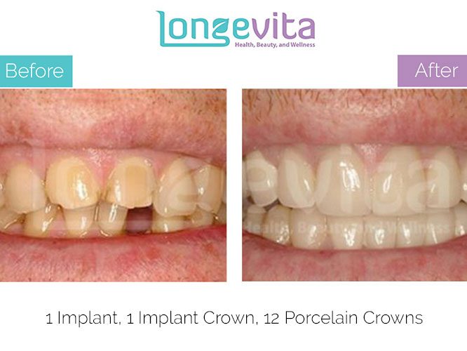 implant crown before and after 2