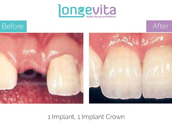 implant crown before and after 3