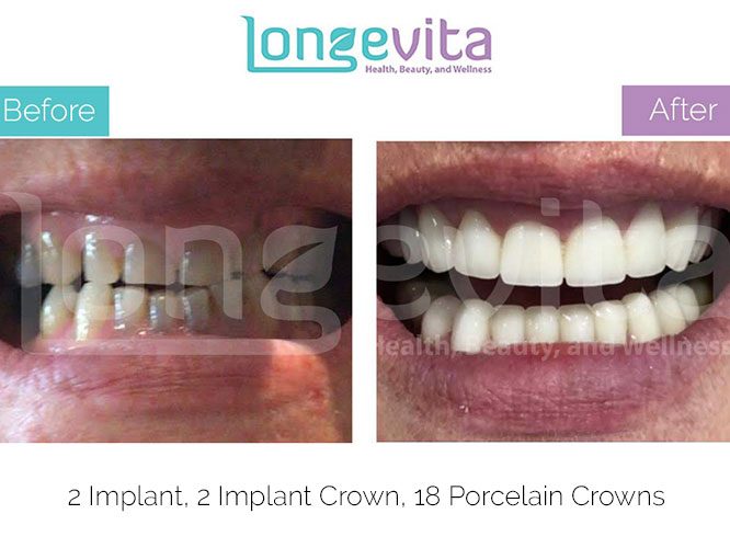 implant crown turkey before and after