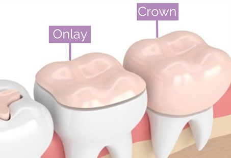 Onlay Vs Crown Which One s Better Longevita Dental Onlay Vs Crown Which One s Better Longevita Dental