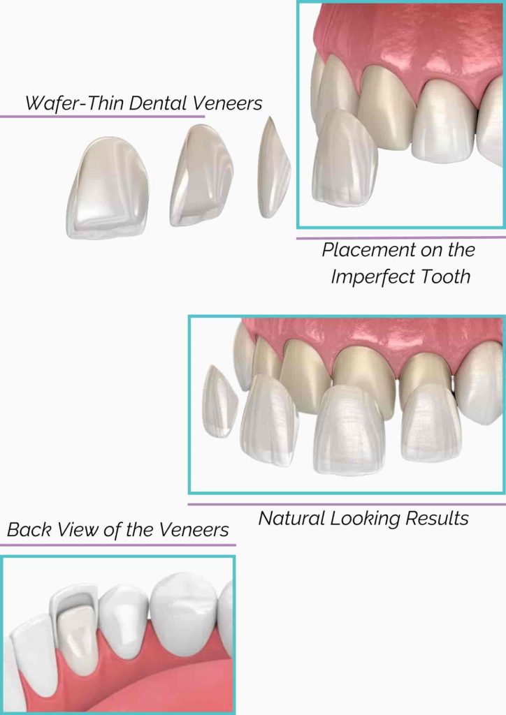 what are dental veneers