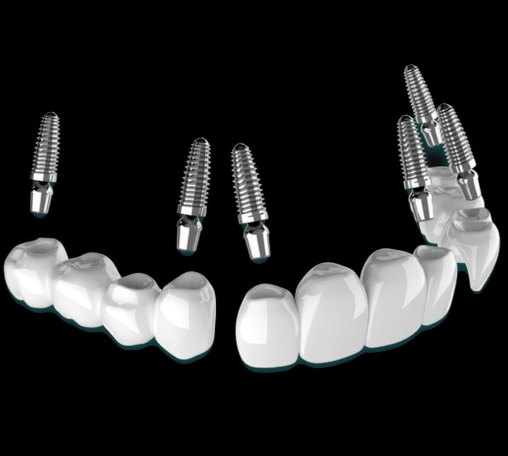 3 on 6 dental implants in mexico by dr moguel 1024x918