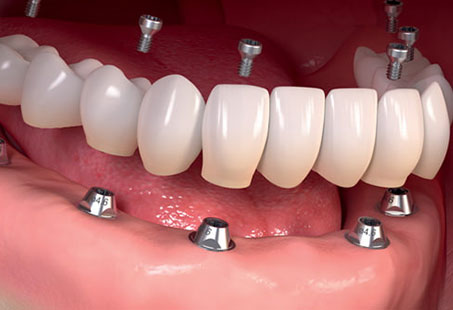 Full Mouth Dental Implants Turkey Deals