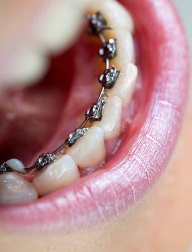 Miley lingual braces