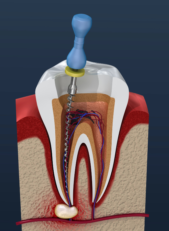 Root canal procedure 1