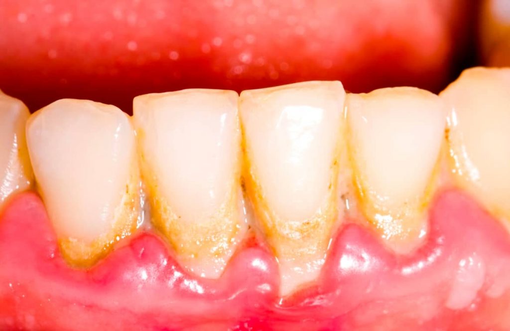 Teeth plaque (2)
