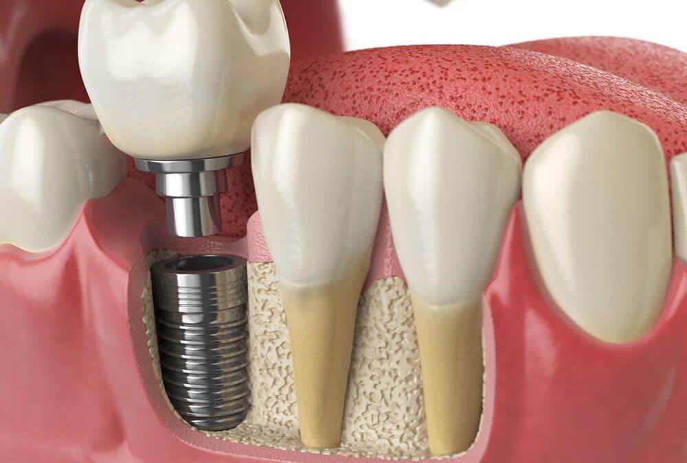 Dental implant in bone