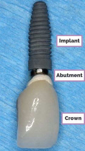 Dental implant structure