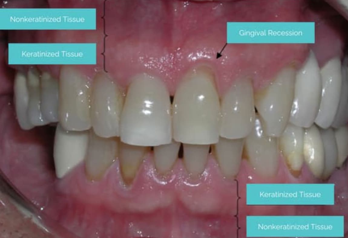 Gum Recession Causes, Reversal & Treatment Longevita