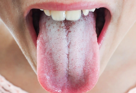 White Tongue