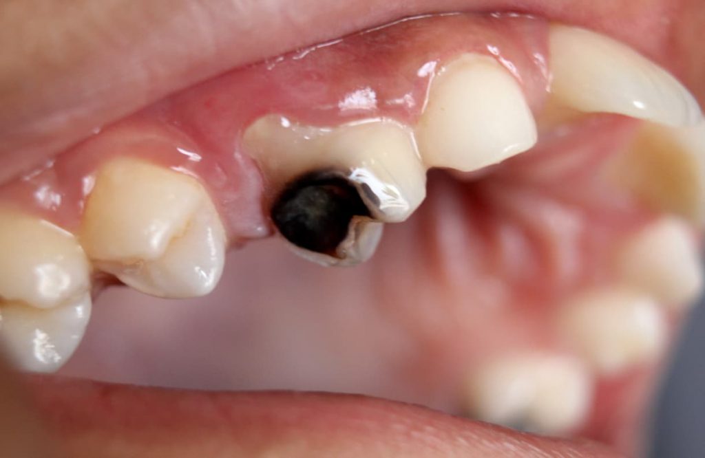 Tooth decay