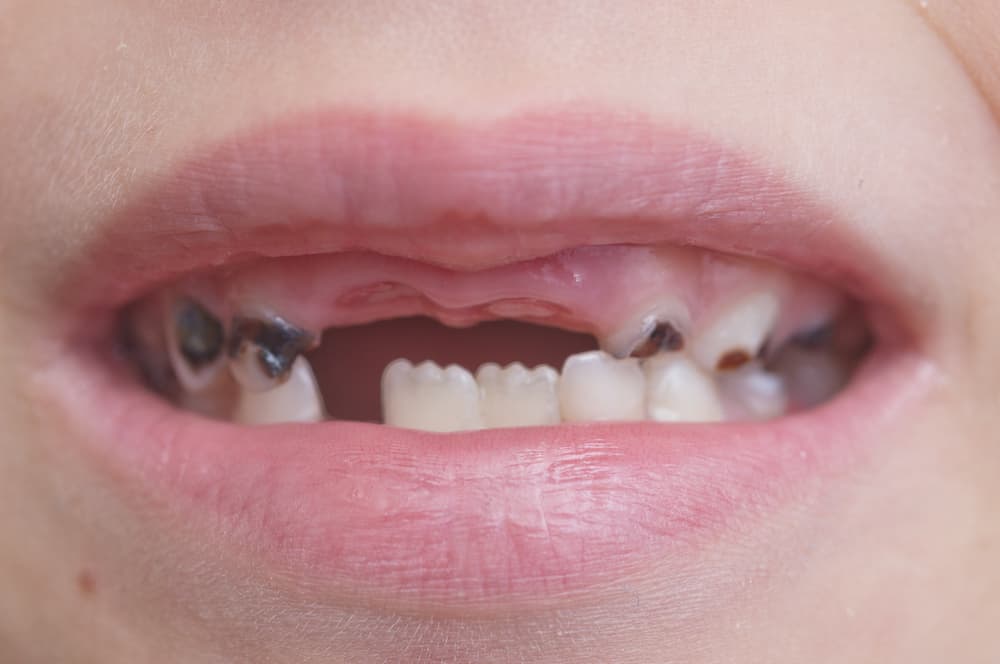 Cavities and jagged teeth