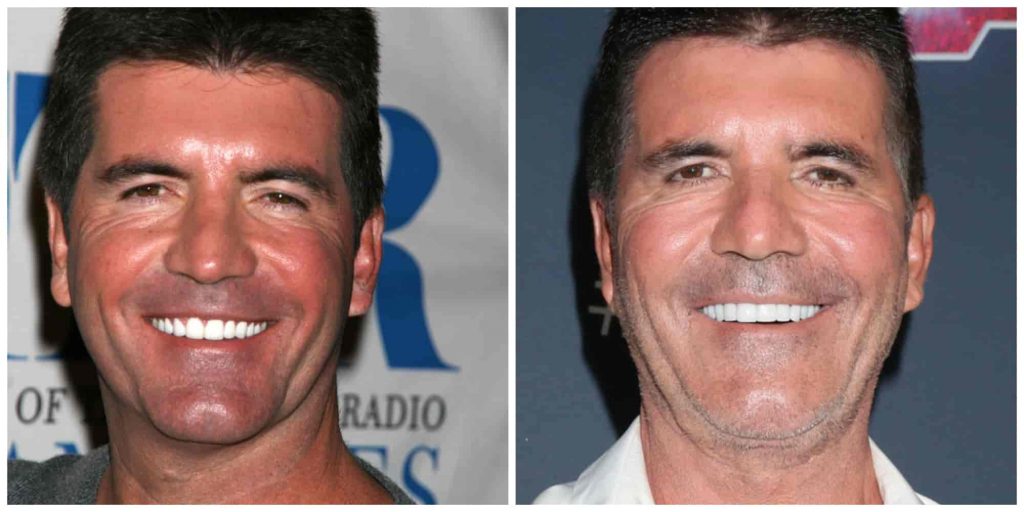 Simon Cowells teeth before and after