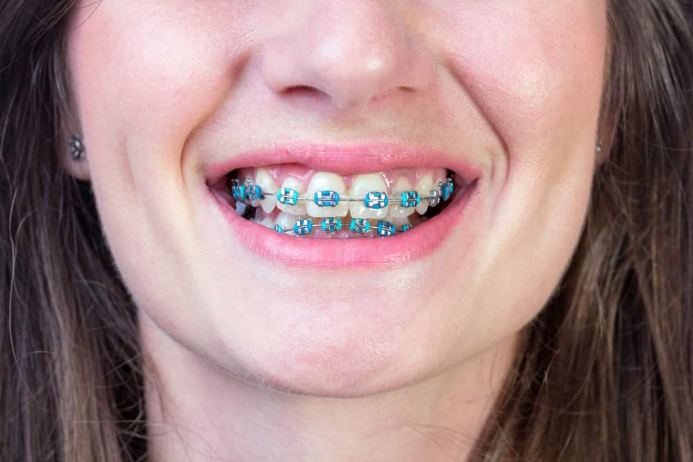 braces teeth