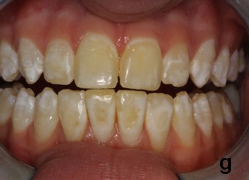 Amelogenesis Imperfecta yellow spots on teeth