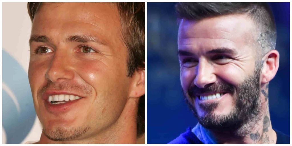 David Beckham teeth before and after