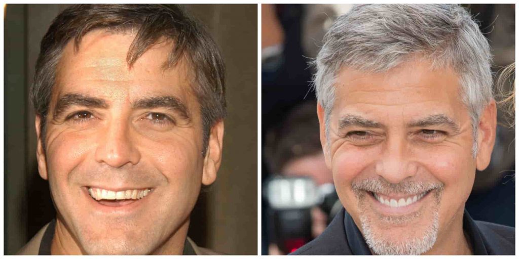 George Clooney teeth before and after