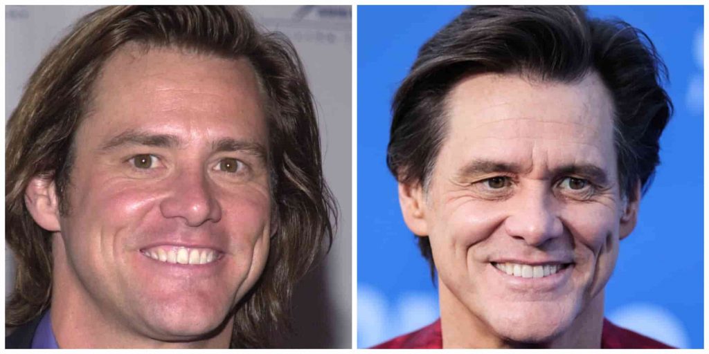 Jim Carreys teeth before and after