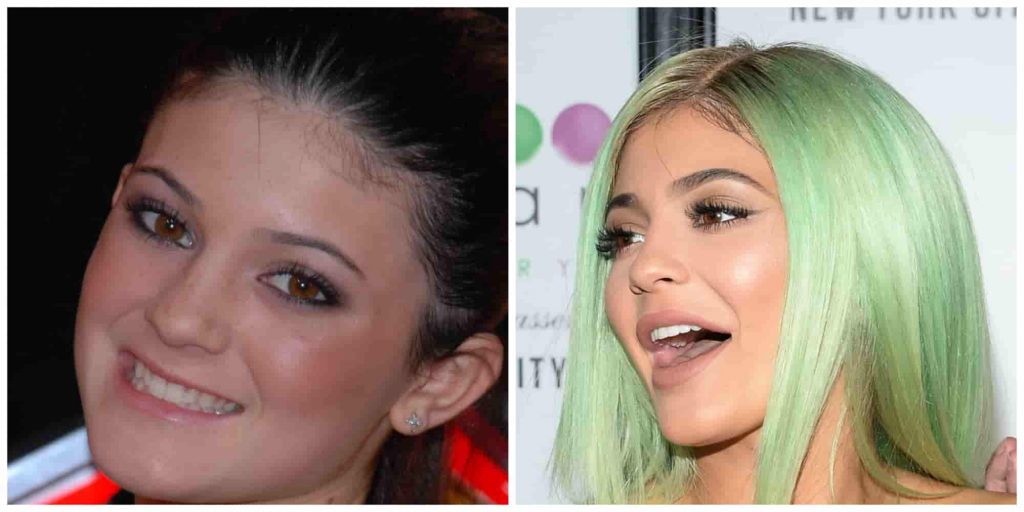 Kylie Jenners teeth before and after