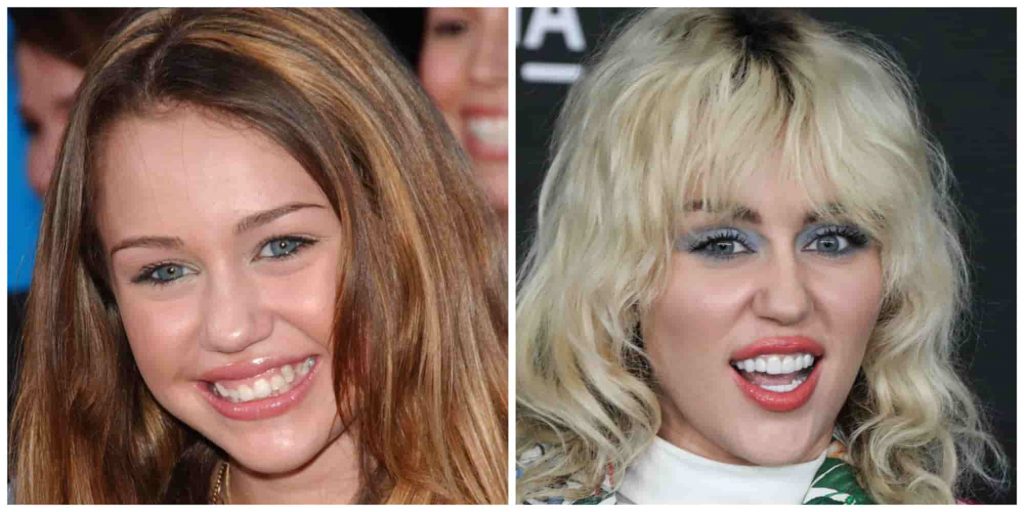Miley Cyrus teeth before and after