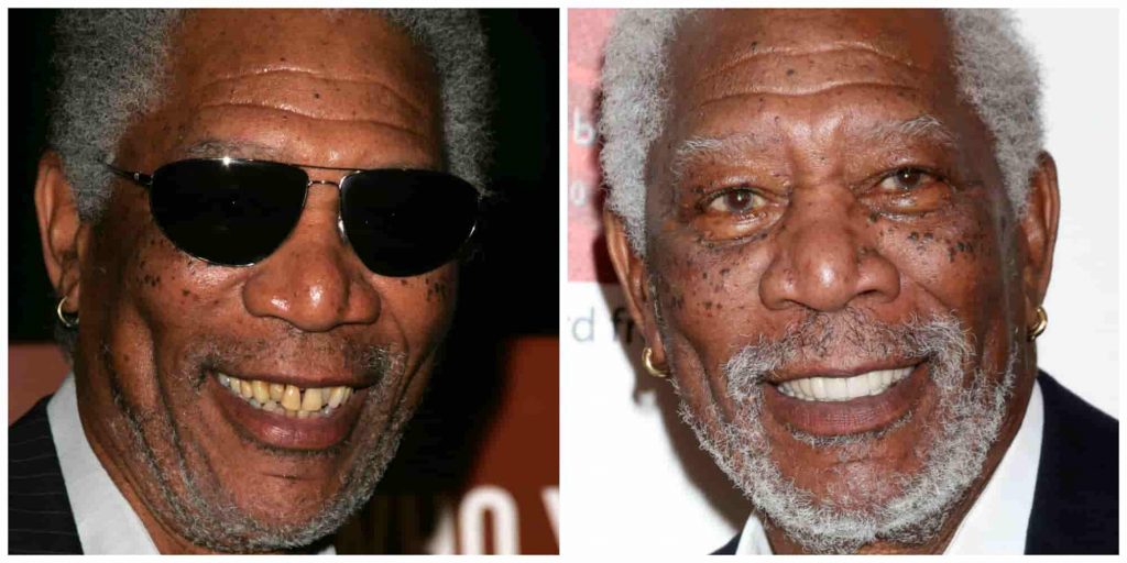 Morgan Freeman's teeth before and after