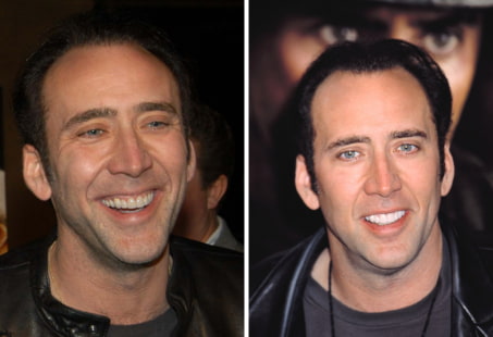 Nicolas cage teeth before and after