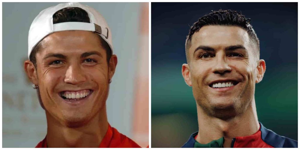 Ronaldo teeth before and after