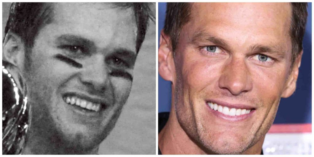 Tom Bradys teeth before and after