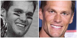 Which Celebrities Have Veneers? | Longevita Dental
