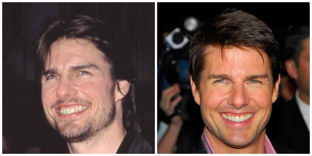 Tom Cruise's teeth before and after