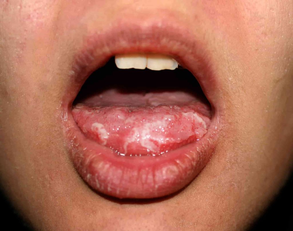 Unhealthy tongue