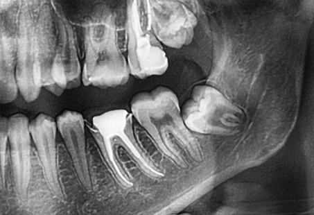 wisdom teeth